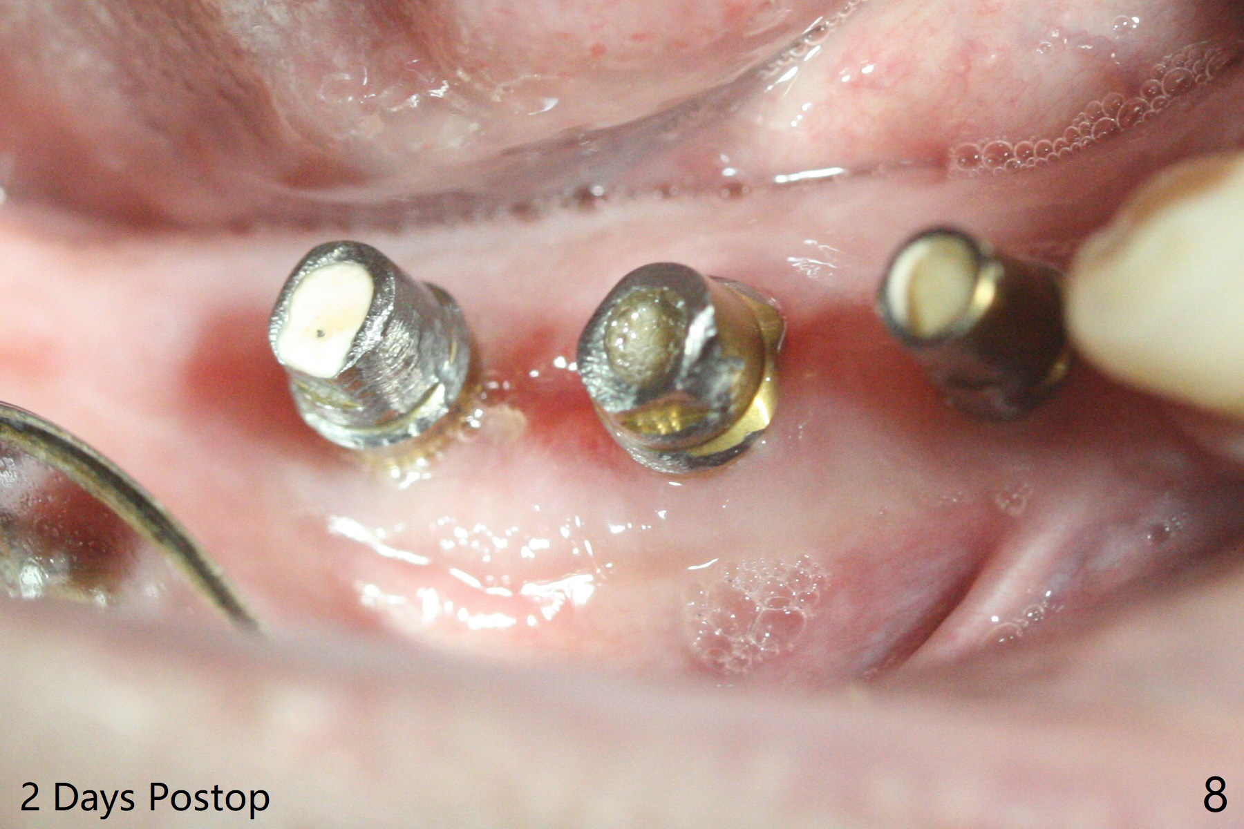 Provisional-Induced Bone Loss Around Implant of Lower 1st